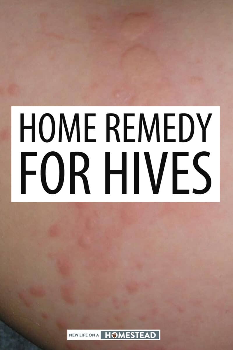 hives remedies pinterest